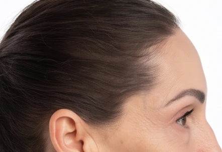 The same hairline after the cover-up