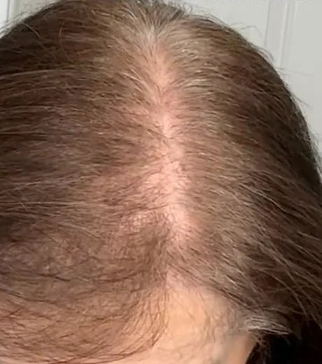 Before: scalp showing along a thinning part on the crown